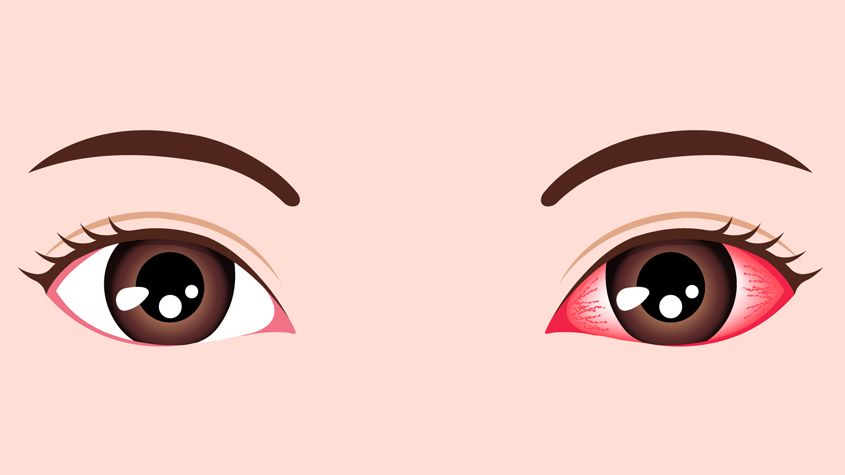 How Contagious is Pink Eye?