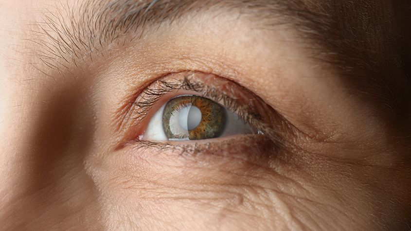 Cataracts and Cataract Surgery: A Simple Explanation from Your Eye Doctor