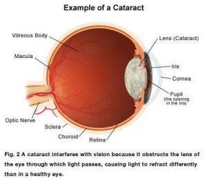 diagram of cataract