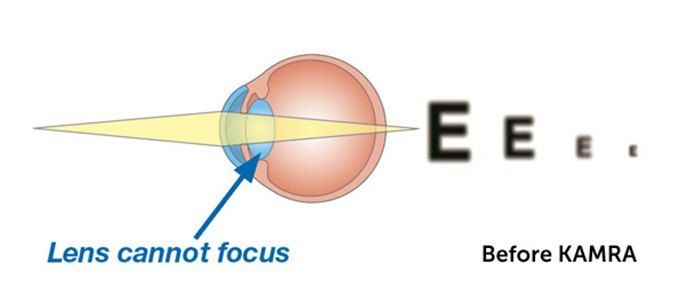 Lens Before KAMRA