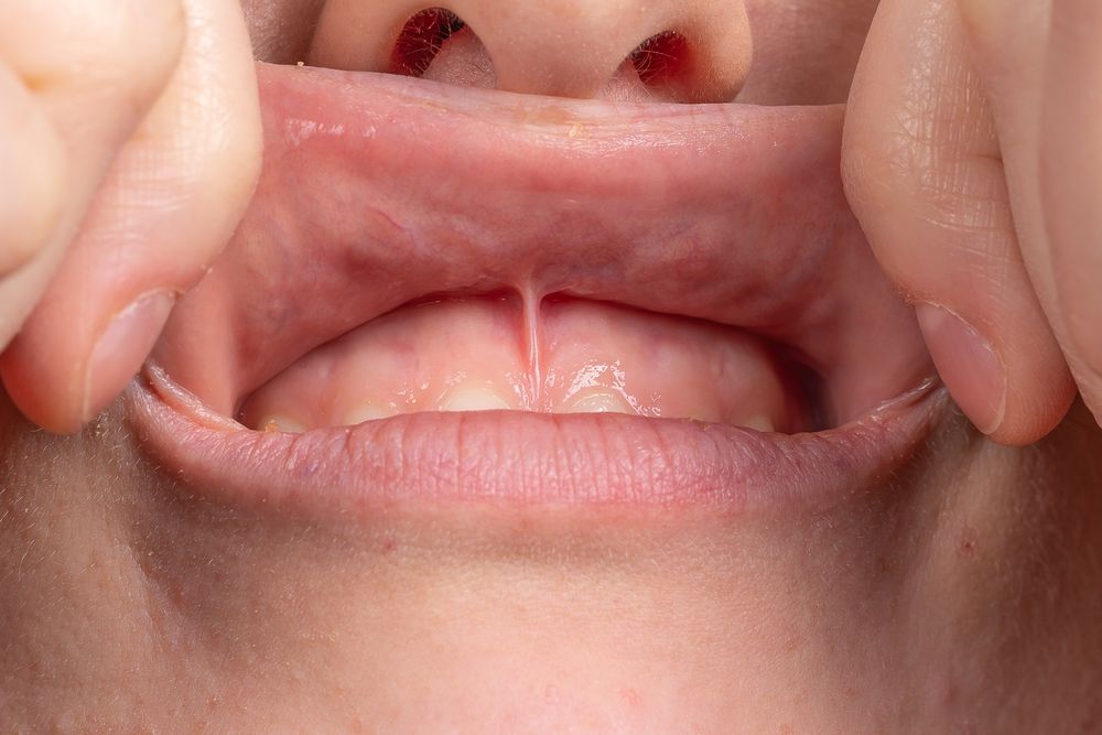 The Ultimate Guide to Post Labial Frenectomy Care