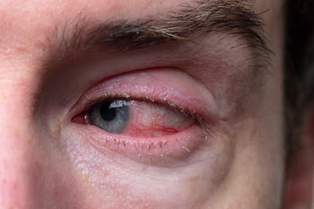 Understanding Pink Eye: Causes, Symptoms, and Types