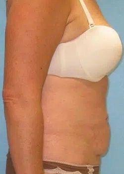 Abdominoplasty Before 1