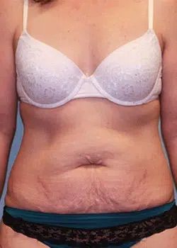 Abdominoplasty Before 1