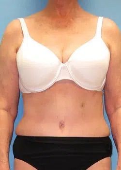 Abdominoplasty After 1