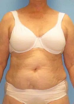 Abdominoplasty Before 1