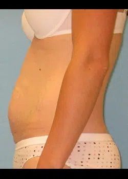 Abdominoplasty Before 1