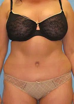 Abdominoplasty After 1