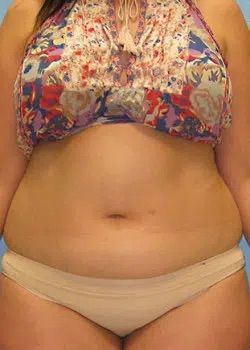 Abdominoplasty Before 1