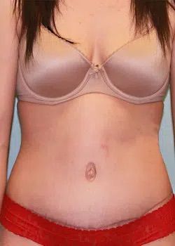 Abdominoplasty After 1