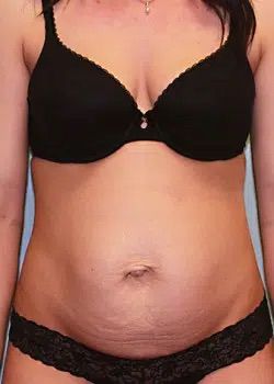 Abdominoplasty Before 1