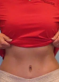 Abdominoplasty After 1