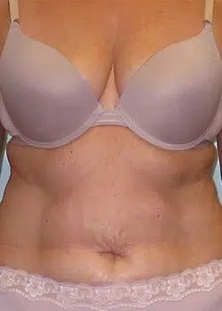 Abdominoplasty Before 1