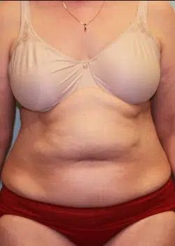 Abdominoplasty Before 1