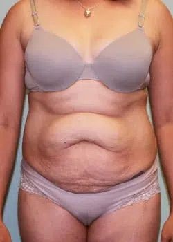 Abdominoplasty Before 1