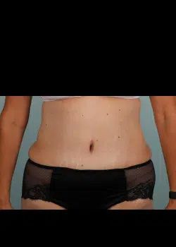 Abdominoplasty After 1