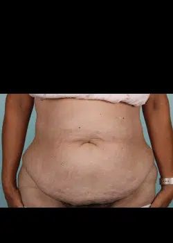 Abdominoplasty Before 1