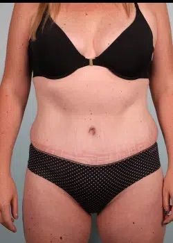 Abdominoplasty After 1