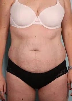 Abdominoplasty Before 1