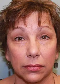 Blepharoplasty After 1