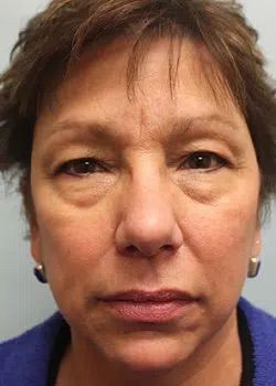 Blepharoplasty Before 1