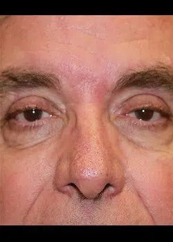 Blepharoplasty After 1