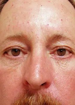 Blepharoplasty After 1