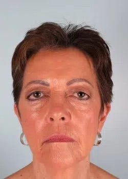 Blepharoplasty Before 1