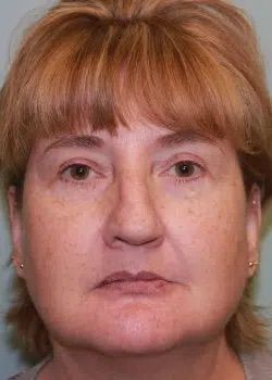 Blepharoplasty After 1