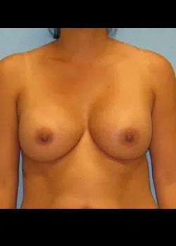 Breast augmentation After 1