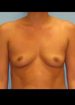 Breast augmentation Before 1