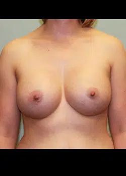 Breast augmentation After 1