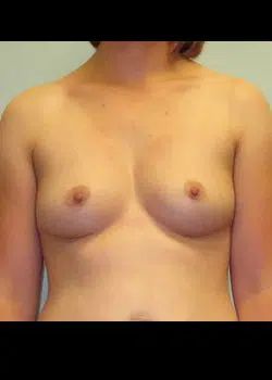 Breast augmentation Before 1