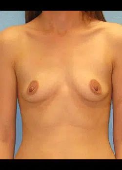 Breast Augmentation Before 1