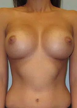 Breast augmentation After 1