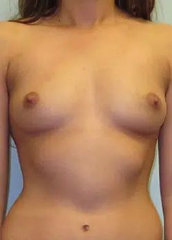 Breast augmentation Before 1