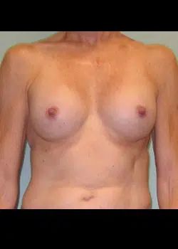 Breast Augmentation After 1