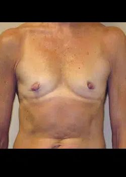 Breast Augmentation Before 1