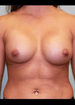 Breast augmentation After 1