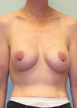 Breast augmentation After 1