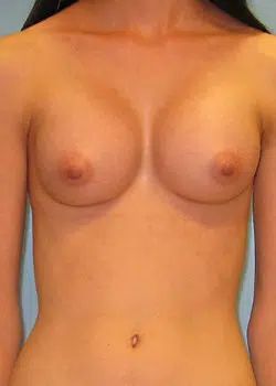 Breast Augmentation After 1