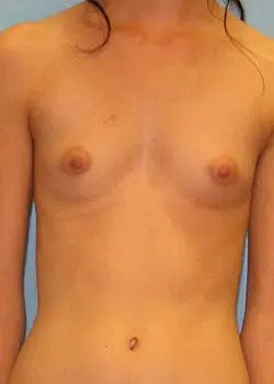 Breast Augmentation Before 1