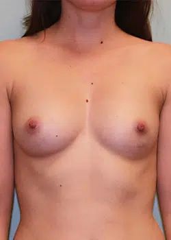 Breast Augmentation Before 1