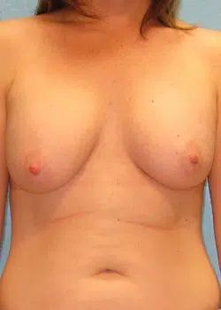 Breast Augmentation After 1