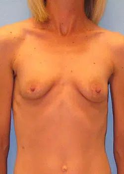 Breast Augmentation Before 1