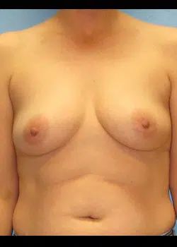 Breast Augmentation Before 1