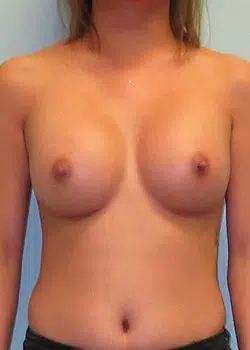 Breast Augmentation After 1