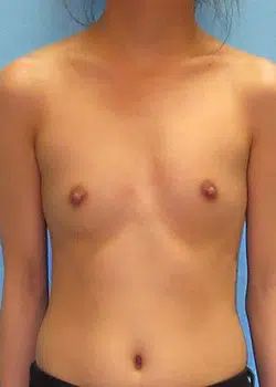 Breast Augmentation Before 1