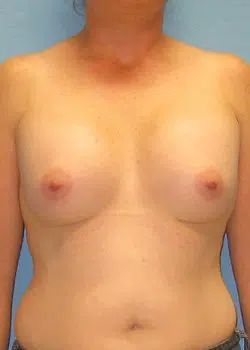 Breast Augmentation After 1