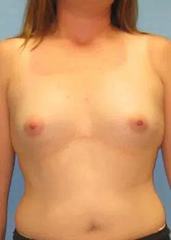 Breast Augmentation Before 1